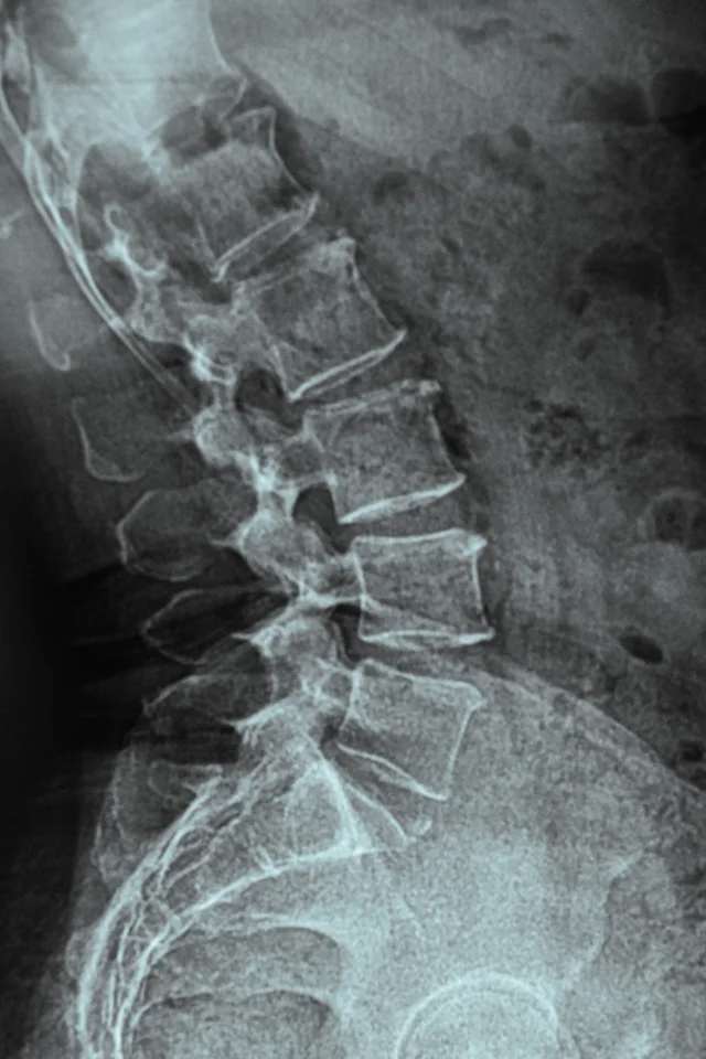 condition-spinal-disorder-img-4-iMsk-Spine